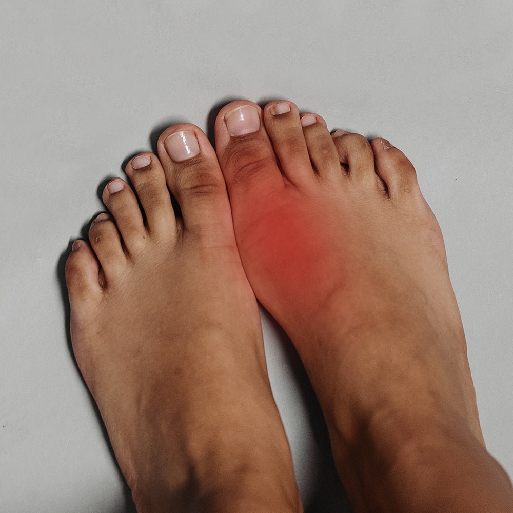 gikt-inflammation-i-stortåled