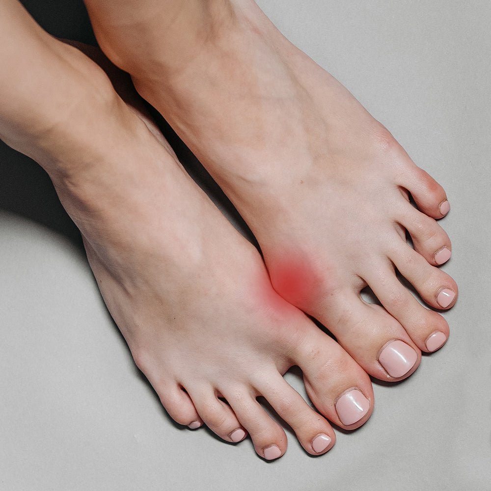 hallux-valgus