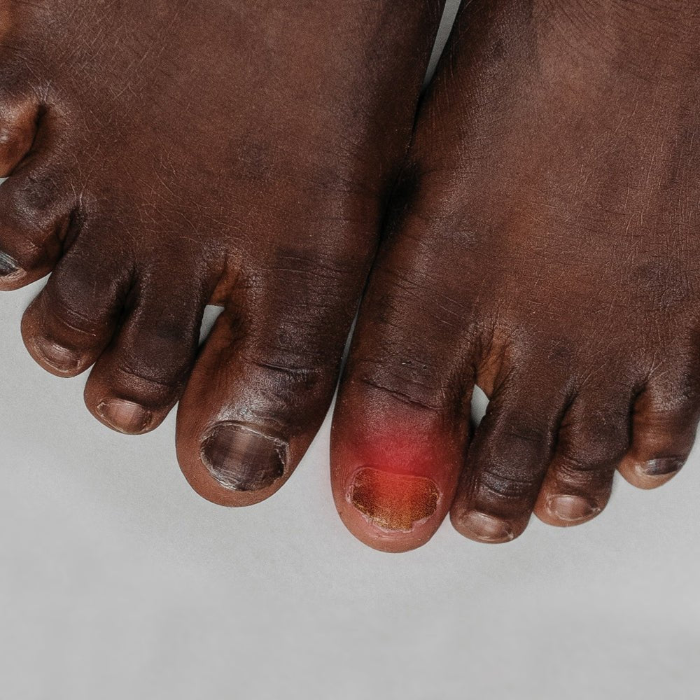 nagelsvamp